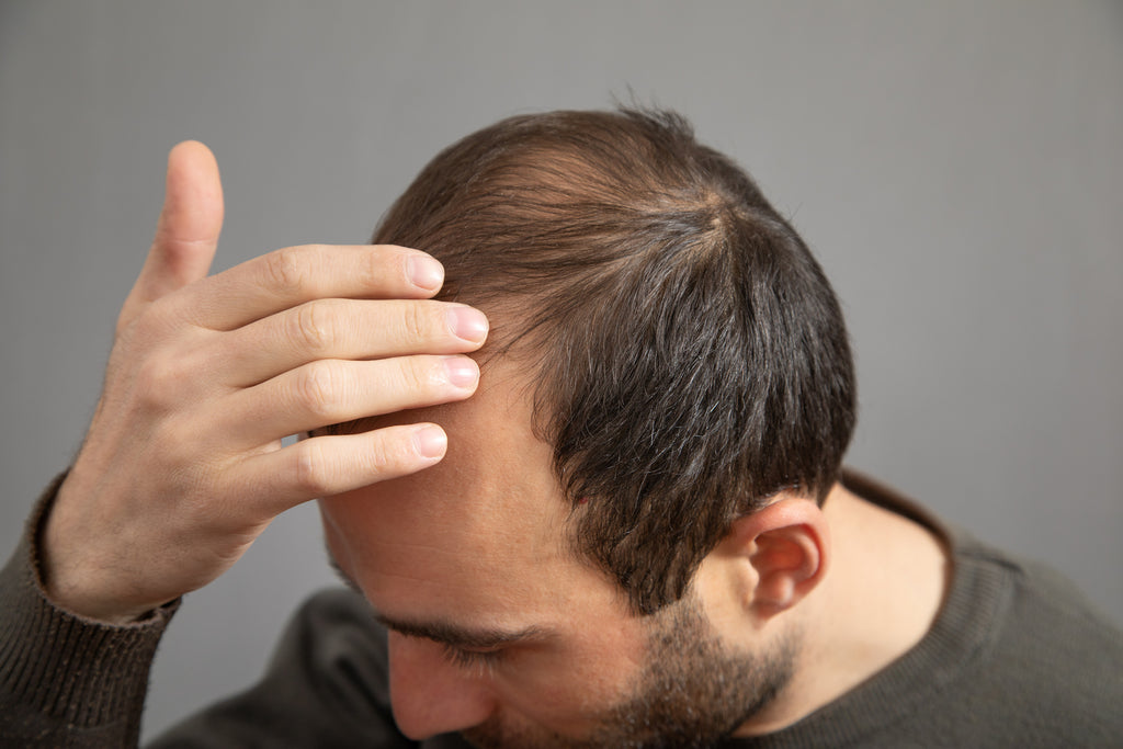 Cómo Combatir la Alopecia: Guía Completa para Hombres y Mujeres